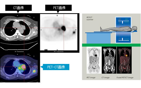 PET CTとは