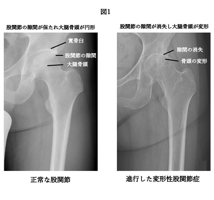 正常な股関節進行した変形性股関節症

